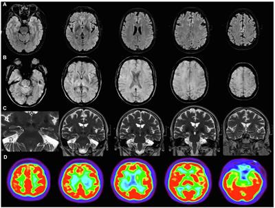 “Brain Fog” by COVID-19 or Alzheimer’s Disease? A Case Report